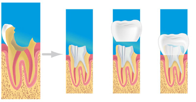 Pose de prothèse dentaire pour protéger une dent